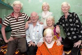 Кто такие люди-альбиносы?